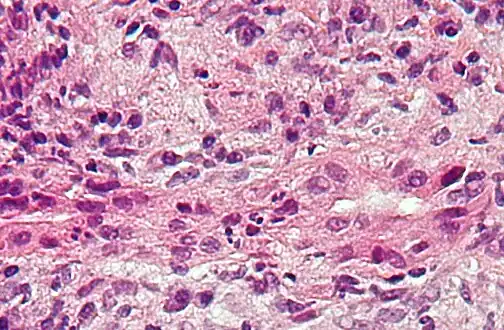 Micrograph of PBC showing bile duct inflammation and injury.