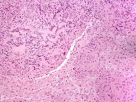 Skin tumors(palisaded encapsulated neuroma)