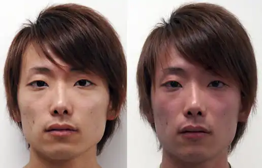 Facial flushing. Before (left) and after (right) drinking alcohol. A 22-year-old East Asian man who is ALDH2 heterozygous showing the reaction.